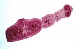 Hastanın karaciğerinden 600 gram kist çıktı