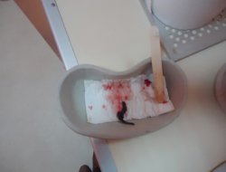 Hastaneye Kaldırılan Çocuğun Genizinden Sülük Çıktı