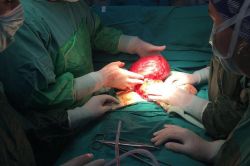 Rahminde 6,5 kg dev miyom çıkarıldı