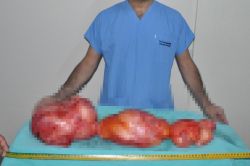 Karnından 125 cm büyüklüğünde kitle çıkarıldı!