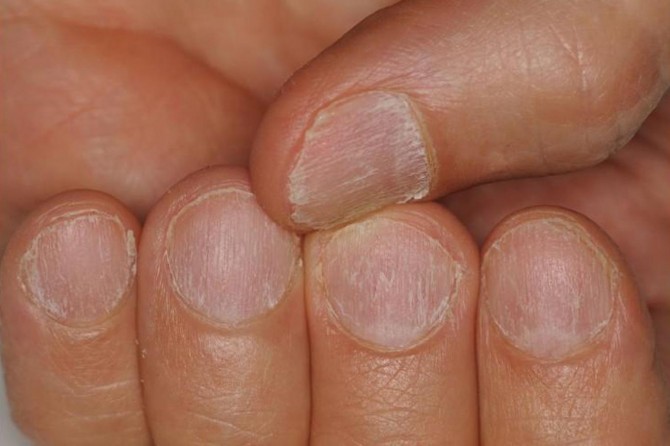 Tırnak sorunlarınızı ciddiye alın