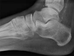 Kireçlenme Daha Çok Bayanlarda Görülür