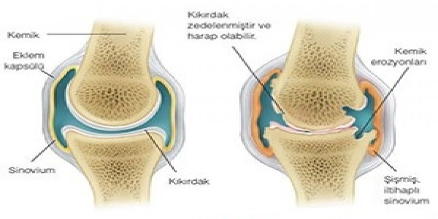 “Diz ağrıları yaşamınızı kısıtlamasın”