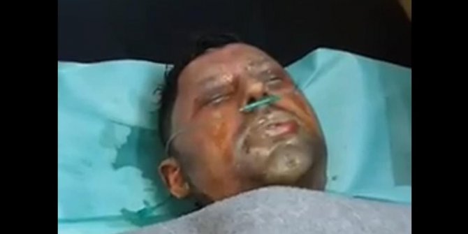 PYD’nin zulmü karşısında kendini yaktı