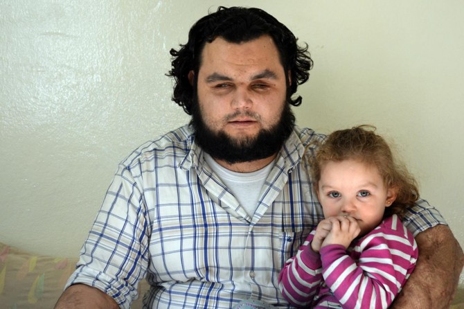 Gözlerini kaybeden Suriyeli gencin tek hayali kızını görebilmek