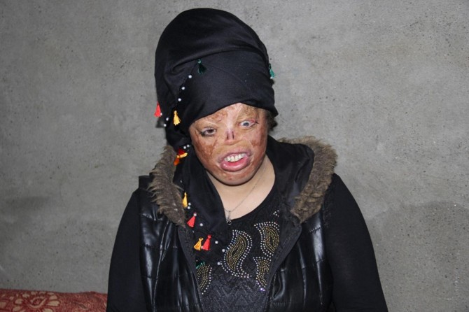 Qîza ku rûyê wê şewitiye li benda alîkariyê ye