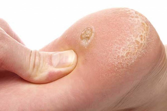 Uzmanlar ayak mantarına karşı uyardı