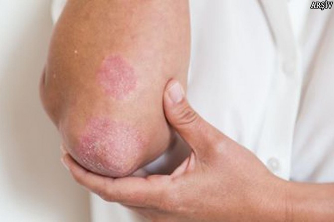 "Sedef hastalığı sadece deriye özgü değildir"