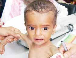 Yemen'de 10 Milyon İnsan Açlığın Pençesinde