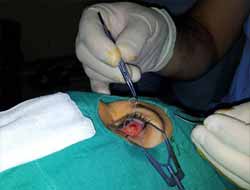 Hastanın Gözünden 10 Cm'lik Parazit Çıktı!