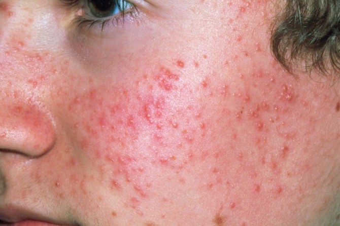 Vücudunuzdaki sivilceleri sakın sıkmayın!