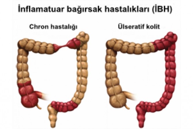 İnflamatuvar bağırsak hastası olabilirsiniz!