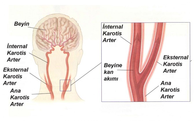 Şah Damarı tıkanıklığı felce neden olabilir
