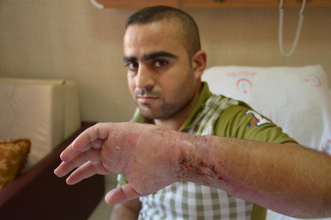 Şanlıurfa’da bilekten kopan el yerine dikildi