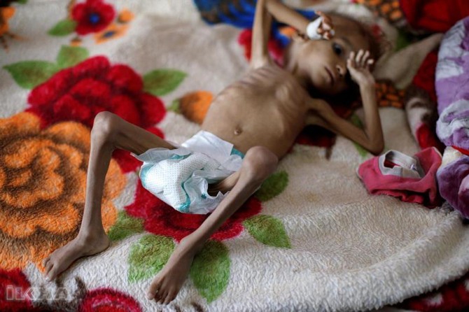 Around 14 million people in Yemen are facing "pre-famine conditions"