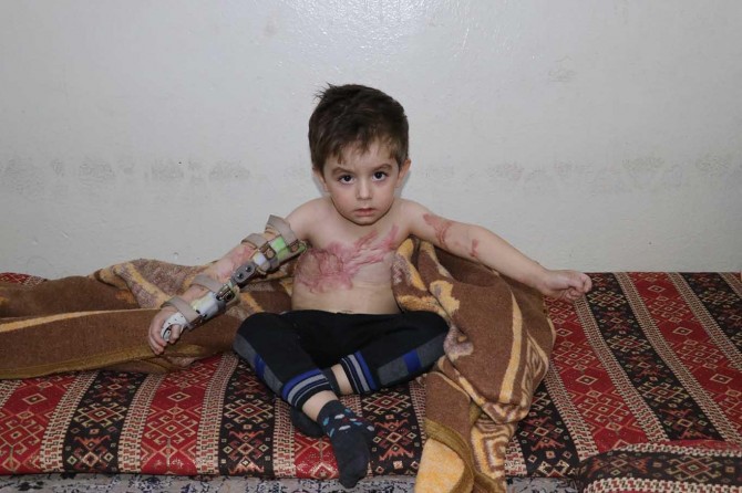 The little boy waiting for help for his burned body