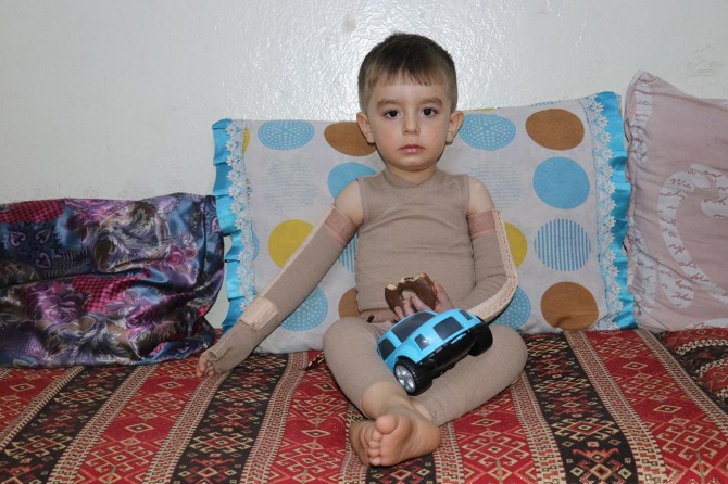 ​Gaziantep’te vücudu yanan küçük çocuğa yardım eli uzatıldı