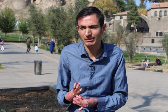 Kelebek hastaları farkındalık istiyor