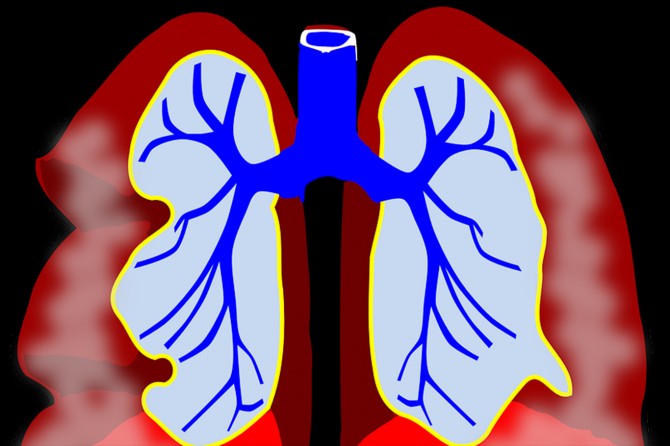 Kuru ve şiddetli öksürük trakeit işareti olabilir