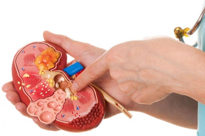 Böbrek taşları hiçbir belirti vermeden oluşabiliyor