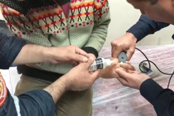 ​Şanlıurfa’da itfaiyeden acil serviste yüzük operasyonu