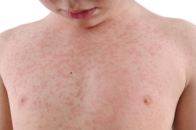 Dünya Sağlık Örgütünden kızamık uyarısı