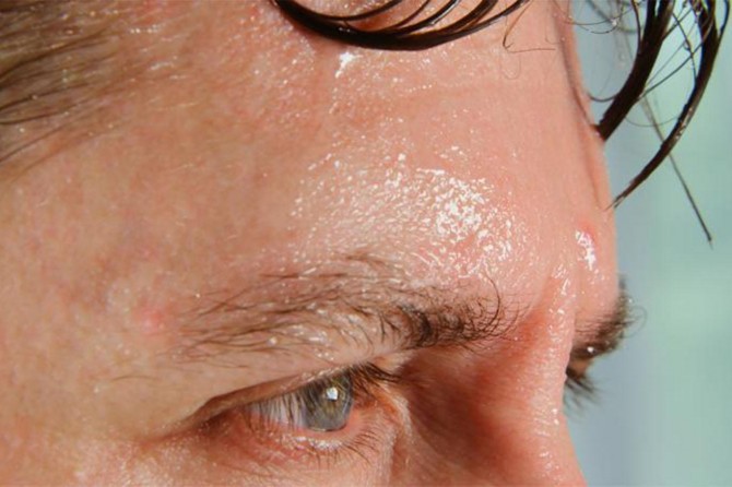 Xwêdana zêde dibe ku nîşaneya nexweşîyan be