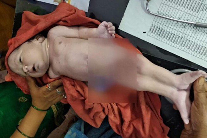Hindistan'da denizkızı sendromlu bebek doğdu