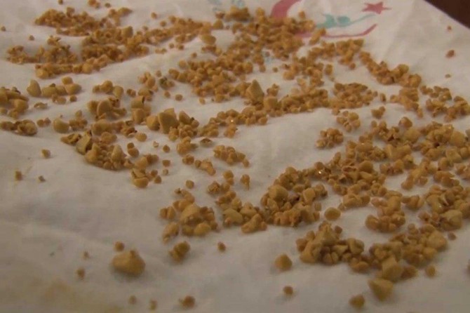 Safra kesesinden bin 50 adet taş çıkarıldı