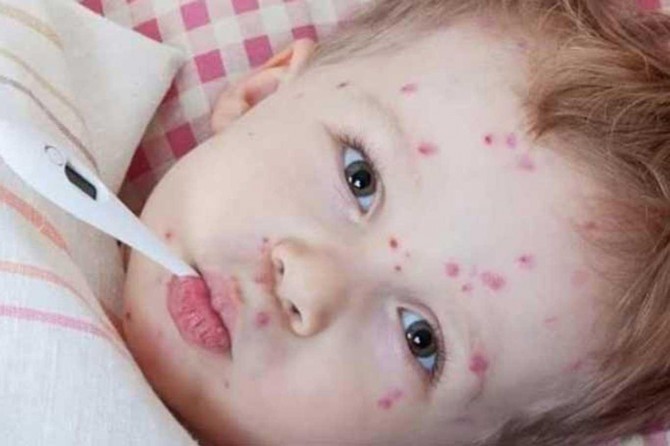 Kızamık vakalarındaki artış dikkat çekiyor