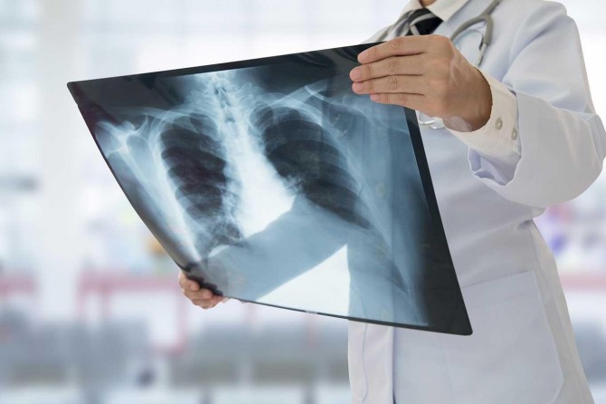 Sigaradan uzak durarak kansere karşı önlem al