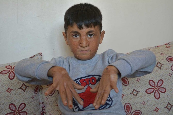 Yüzü ve elleri yanan küçük çocuk yardım bekliyor