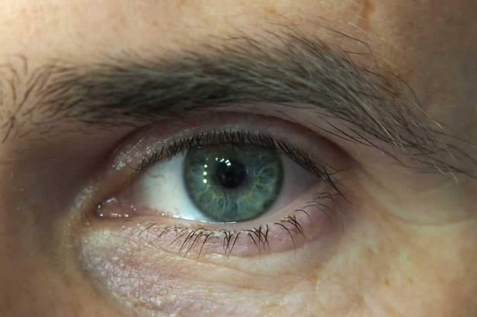 Gözleri sık ovalamak keratokonus hastalığına yol açabilir