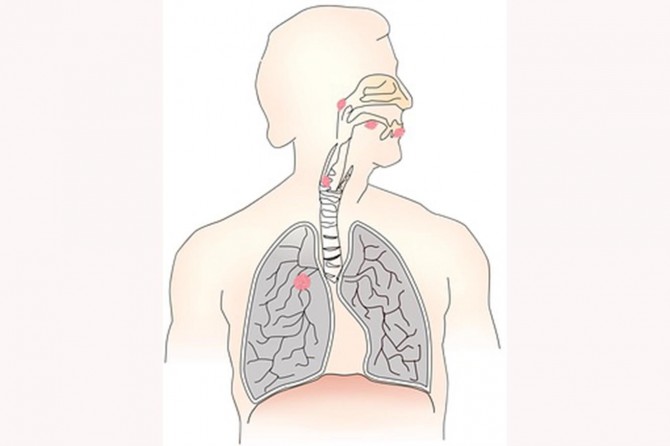TÜSAD: Kronik solunum yetersizliği olanlar için daha özgür bir yaşam egzersiz ile mümkün