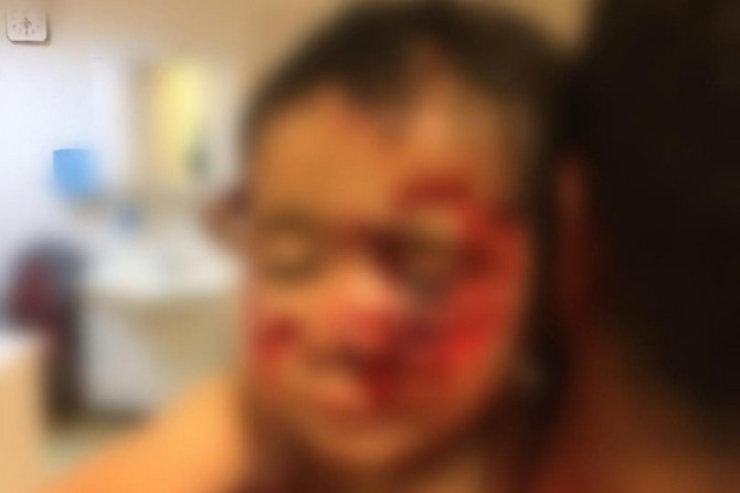 Viranşehir'de köpeklerin saldırısında ağır yaralanan çocuk hayatını kaybetti