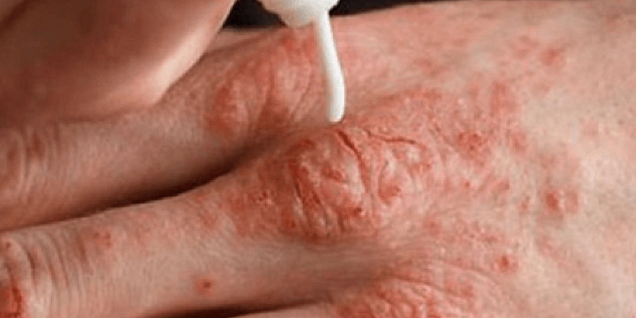 Soğuk havalarda soğuk alerjisine dikkat