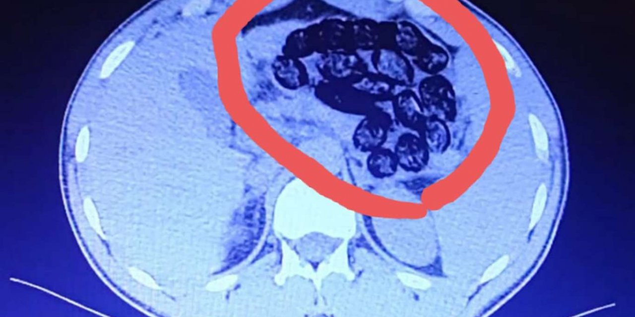 Midelerinden 920 gram uyuşturucu madde çıktı