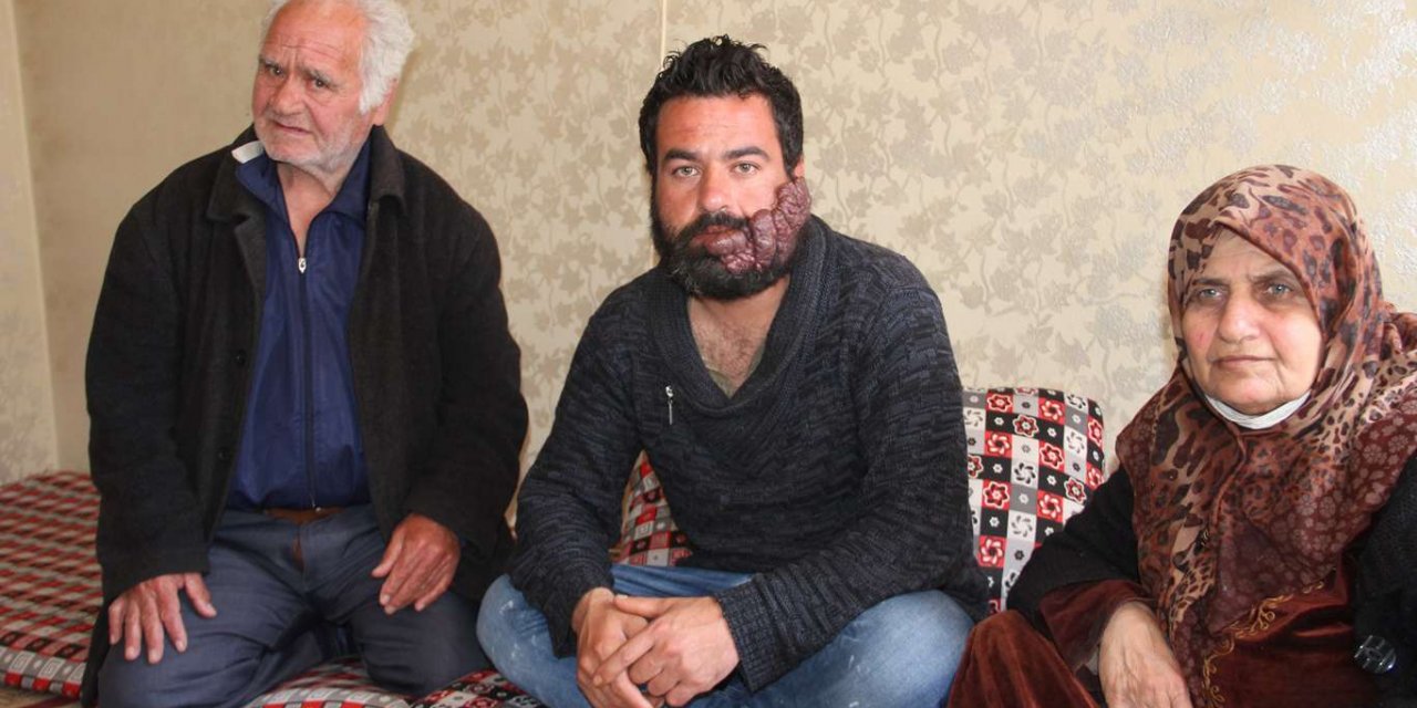 Suriyeli genç, yüzündeki kitlenin ameliyatla alınması için yardım bekliyor