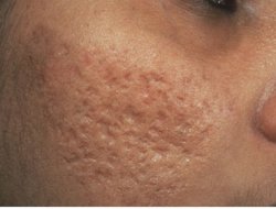 Sivilce izlerin tedavisinde Mikro İğneleme Yöntemi