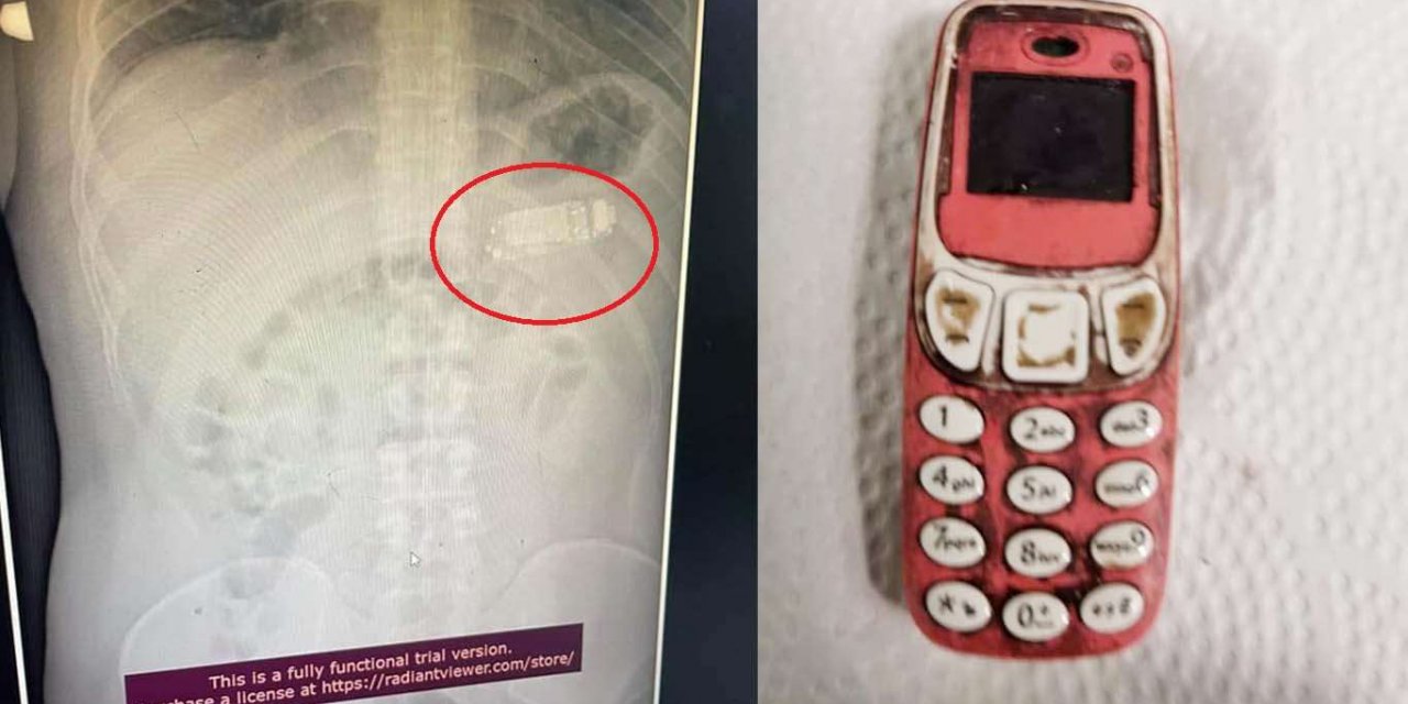 Mide şikayeti ile hastaneye başvuran adamın karnından telefon çıktı