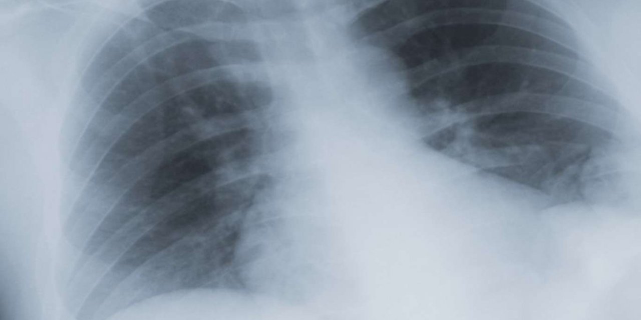 Sigara akciğer kanseri riskini arttırıyor