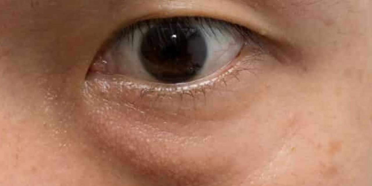 Göz altı torbalanmalarına dikkat!