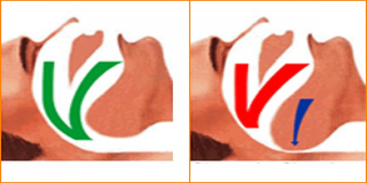 Horlama bir hastalık mıdır?