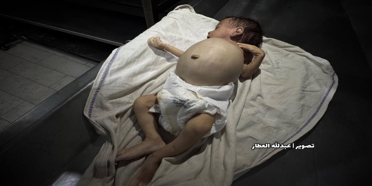 Gazze’de açlıktan şehit olanların sayısı 399’a yükseldi