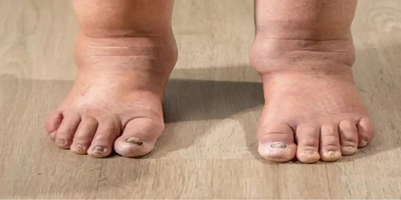 Kollarınızda veya bacaklarınızda şişlik varsa nedeni lenfödem olabilir!