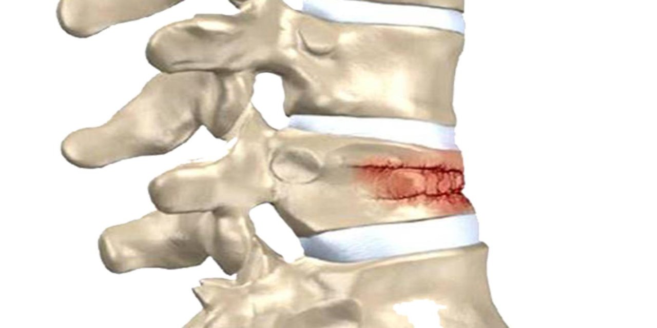 Omurga kırıkları kış aylarında artıyor