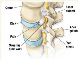 Fıtık tedavisinde yeni yöntem