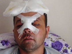 İlahi ses sanatçısı bir gözünü kaybetti