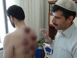 Şifa kaynağı sünnetlerden: Hacamat