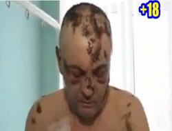 Etleri çürüyor, organları kopuyor